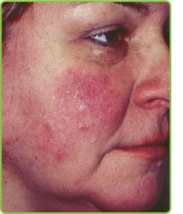 eyelid rosacea